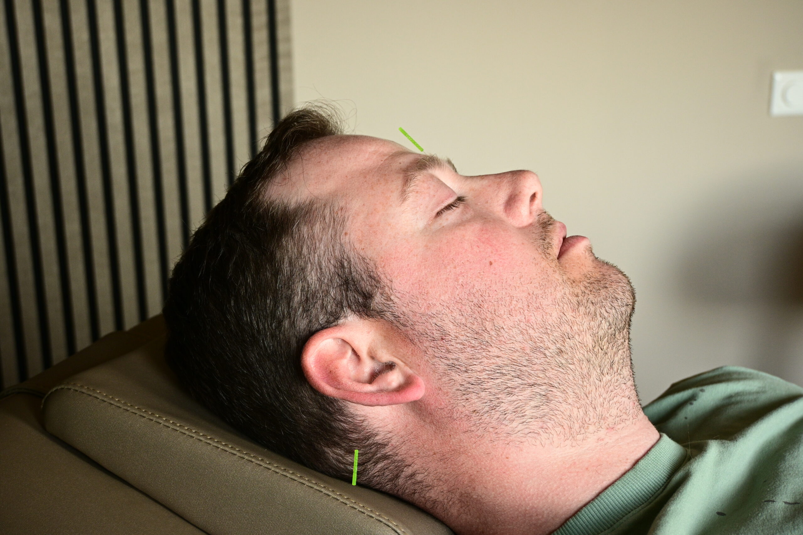 Acupunctuur bij migraine
