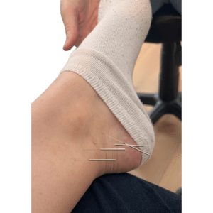 Acupunctuur bij vrouwenklachten